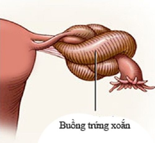 Xoắn buồng trứng - Hình ảnh minh họa